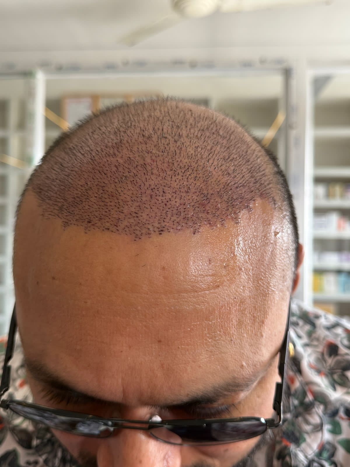 Hair Transplant FUE DHI at Revive Nepal